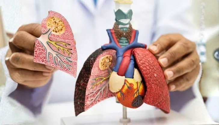Lung Cancer Image